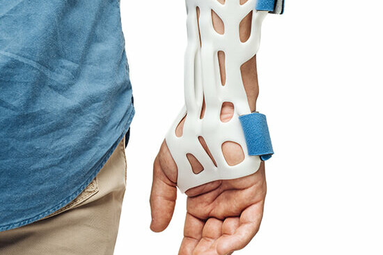 Órtese personalizada impressa em 3D, aplicação típica de filamento de engenharia